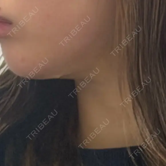 糸リフト / 脂肪吸引（顔） / 水光注射（ハリ・美肌） Wing clinic 豊中駅前院 DAY 10 メイン用