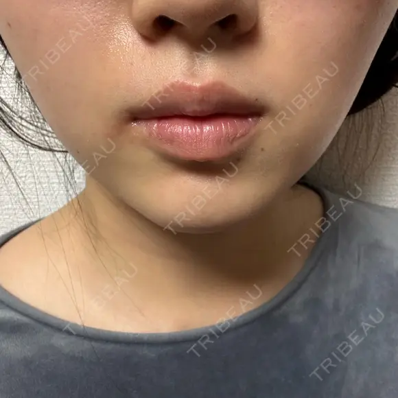 ボトックス（エラ・小顔） / ボトックス（肩） TCB東京中央美容外科 中野院 AFTER メイン用