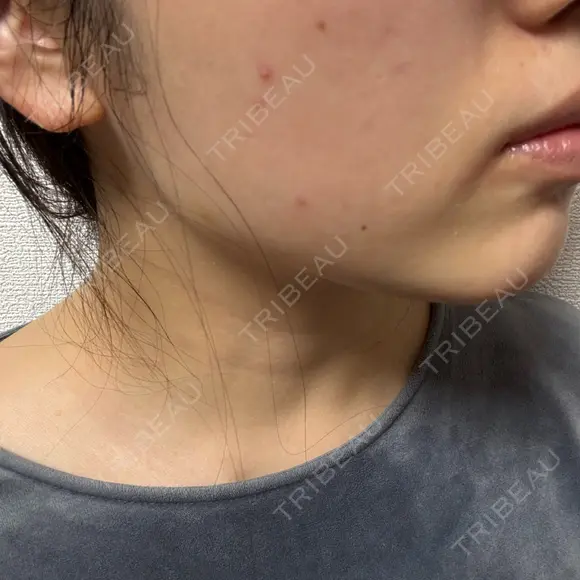 ボトックス（エラ・小顔） / ボトックス（肩） TCB東京中央美容外科 中野院 DAY 4 メイン用