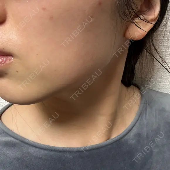 ボトックス（エラ・小顔） / ボトックス（肩） TCB東京中央美容外科 中野院 DAY 4 メイン用