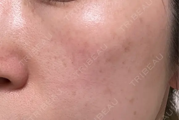 イオン導入 / ピーリング（ハリ・ツヤ） / ルメッカ ルラ美容クリニック 福岡本院 AFTER メイン用