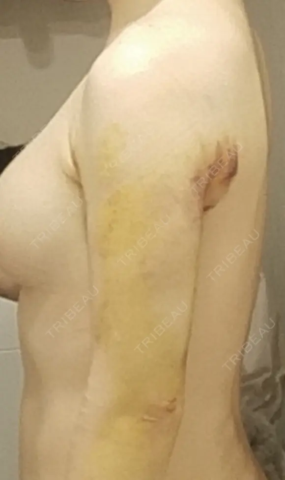 脂肪吸引（二の腕） / 豊胸（脂肪注入） / 乳頭縮小 / 脂肪吸引（肩） MYCLI【マイクリ】大阪・梅田院 DAY 6 メイン用