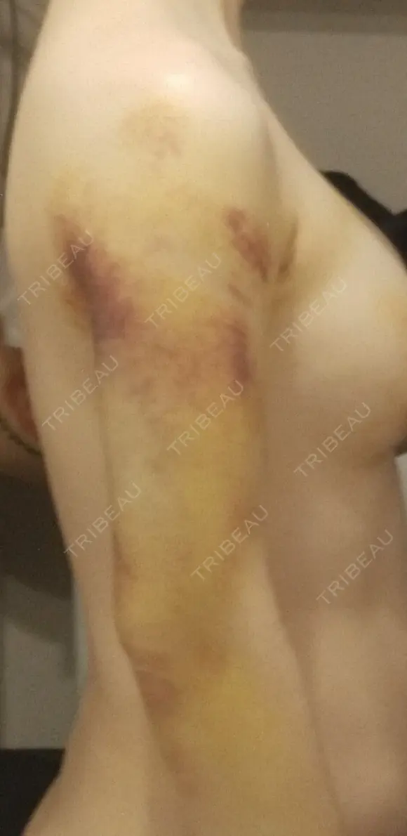 脂肪吸引（二の腕） / 豊胸（脂肪注入） / 乳頭縮小 / 脂肪吸引（肩） MYCLI【マイクリ】大阪・梅田院 DAY 6 メイン用