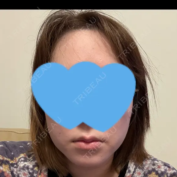 糸リフト / 脂肪吸引（顔） / ジョールファット除去 / 脂肪吸引注射（顔） SEA CLINIC（シークリニック） DAY 29 メイン用