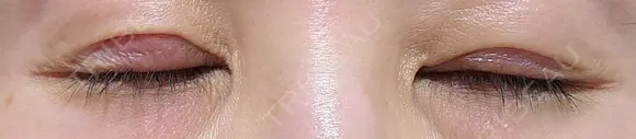 二重切開 / 眼瞼下垂（切開） / 下まぶたの脂肪取り EMMA CLINIC（エマクリニック） DAY 30 メイン用