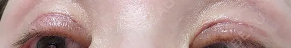 二重切開 / 眼瞼下垂（切開） / 下まぶたの脂肪取り EMMA CLINIC（エマクリニック） DAY 30 メイン用
