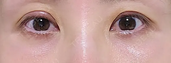 二重切開 / 眼瞼下垂（切開） / 下まぶたの脂肪取り EMMA CLINIC（エマクリニック） DAY 30 メイン用