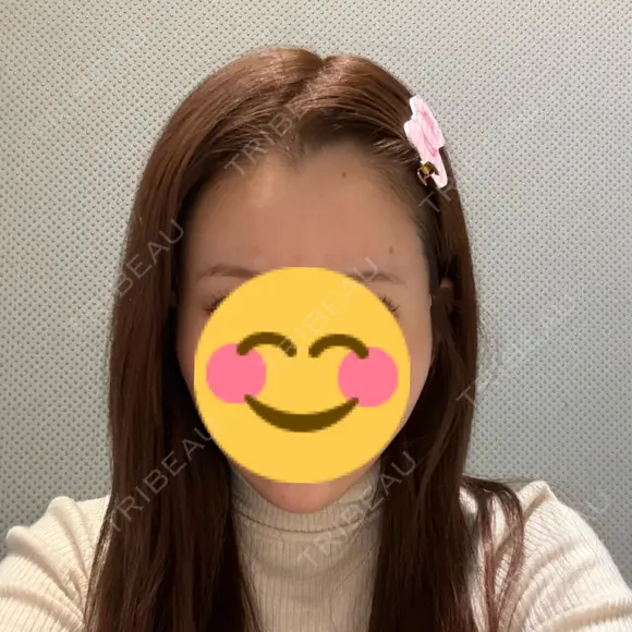 糸リフト 城本クリニック 福岡院 AFTER メイン用