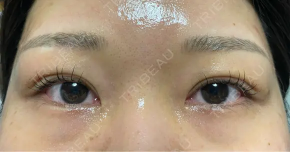 二重埋没 オジスキンクリニック DAY 4 メイン用