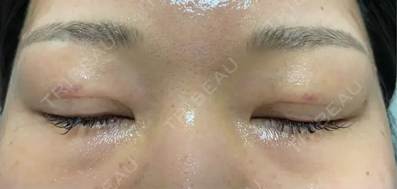 二重埋没 オジスキンクリニック DAY 4 メイン用