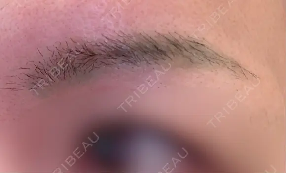 アートメイク除去・修正 東京イセアクリニック AFTER メイン用