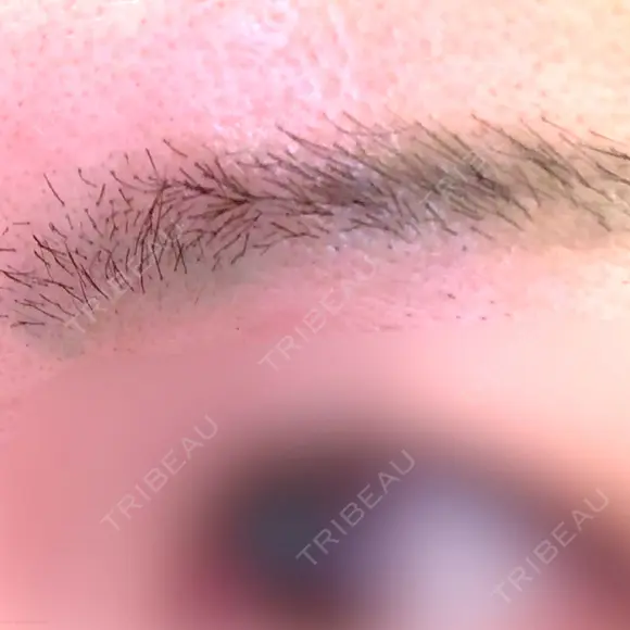 アートメイク除去・修正 東京イセアクリニック DAY 7 メイン用