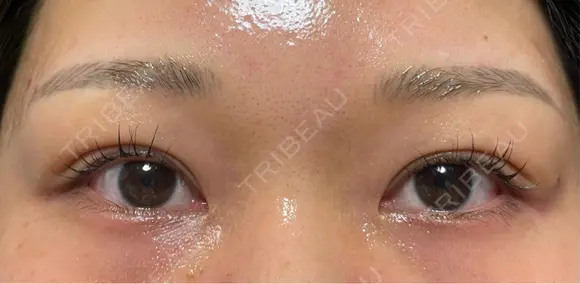 二重埋没 オジスキンクリニック DAY 8 メイン用