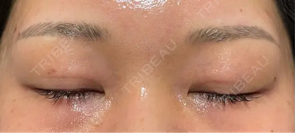 二重埋没 オジスキンクリニック DAY 8 メイン用