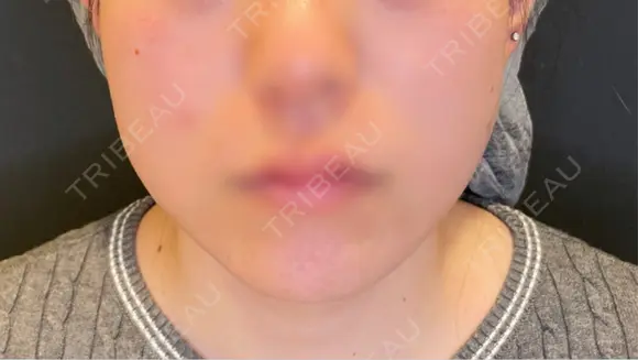 脂肪吸引（顔） / 目尻切開 / タレ目形成・グラマラスライン（埋没） LOUIS CLINIC 二子玉川院【ルイクリニック】 DAY 0 メイン用