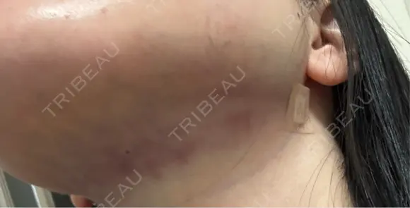 脂肪吸引（顔） / 目尻切開 / タレ目形成・グラマラスライン（埋没） LOUIS CLINIC 二子玉川院【ルイクリニック】 DAY 0 メイン用