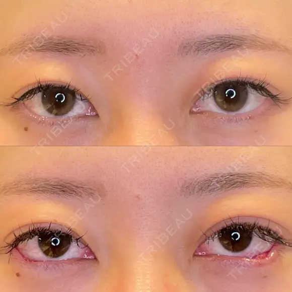 脂肪吸引（顔） / 目尻切開 / タレ目形成・グラマラスライン（埋没） LOUIS CLINIC 二子玉川院【ルイクリニック】 DAY 0 メイン用