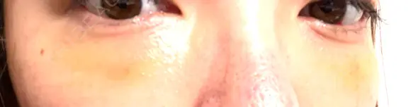 クマ治療 KIMI CLINIC 形成・美容外科 AFTER メイン用