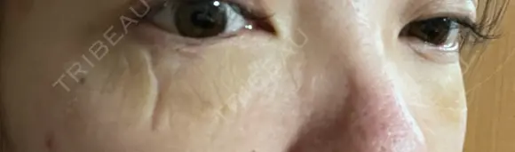 クマ治療 KIMI CLINIC 形成・美容外科 DAY 6 メイン用