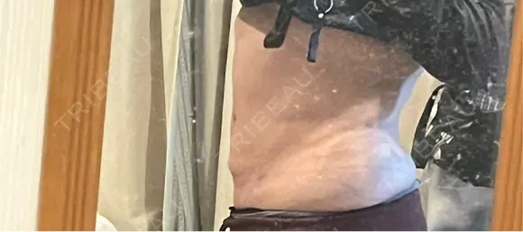 医療痩身（お腹） 渋谷美容外科クリニック 渋谷院 DAY 38 メイン用