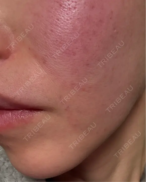 肌ヒアルロン酸注入（たるみ・シワ改善） / ショッピングリフト APスキンクリニック銀座 DAY 0 メイン用