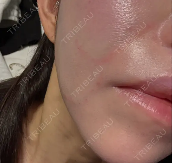 肌ヒアルロン酸注入（たるみ・シワ改善） / ショッピングリフト APスキンクリニック銀座 DAY 0 メイン用