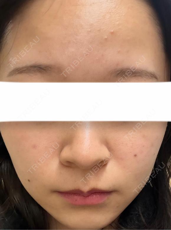 イオン導入 / 光治療（フォトフェイシャルなど） / ルメッカ BITO BEAUTY CLINIC AFTER メイン用