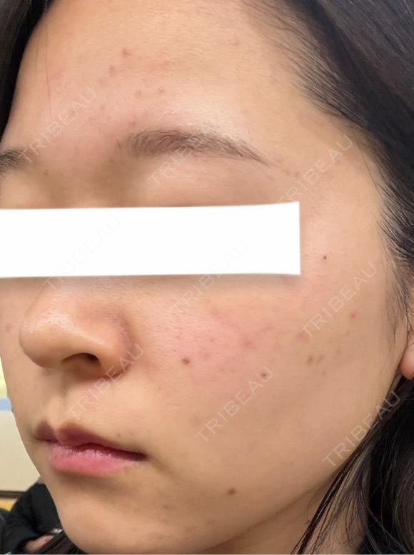 イオン導入 / 光治療（フォトフェイシャルなど） / ルメッカ BITO BEAUTY CLINIC DAY 0 メイン用