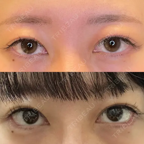 脂肪吸引（顔） / 目尻切開 / タレ目形成・グラマラスライン（埋没） LOUIS CLINIC 二子玉川院【ルイクリニック】 DAY 1 メイン用