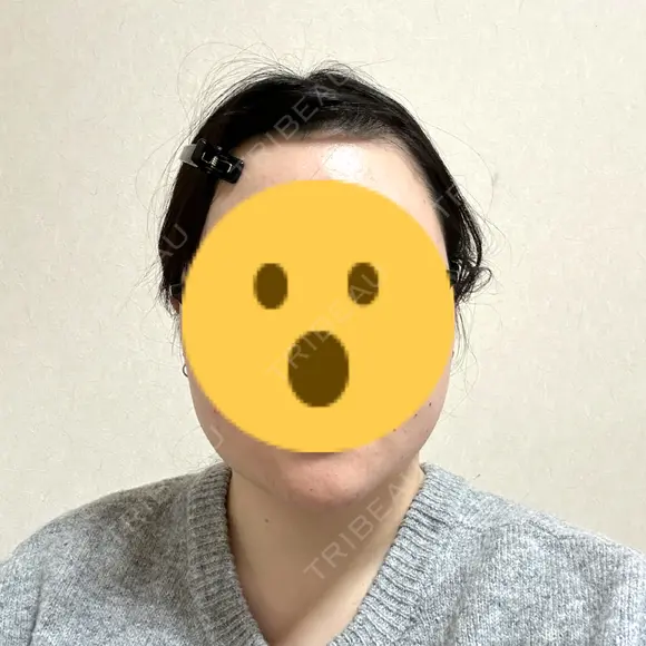 ボトックス（エラ・小顔） フィラークリニック 大阪心斎橋院 DAY 8 メイン用