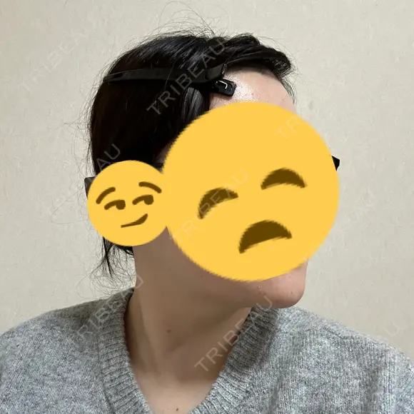 ボトックス（エラ・小顔） フィラークリニック 大阪心斎橋院 DAY 8 メイン用