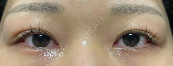 二重埋没 オジスキンクリニック DAY 13 メイン用