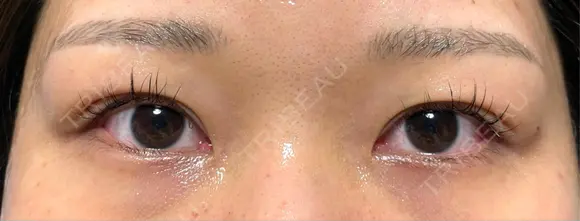 二重埋没 オジスキンクリニック DAY 13 メイン用