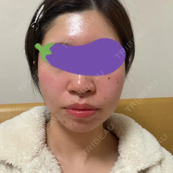 オンダリフト LIGHT CLINIC 【ライトクリニック】 名古屋院 AFTER メイン用