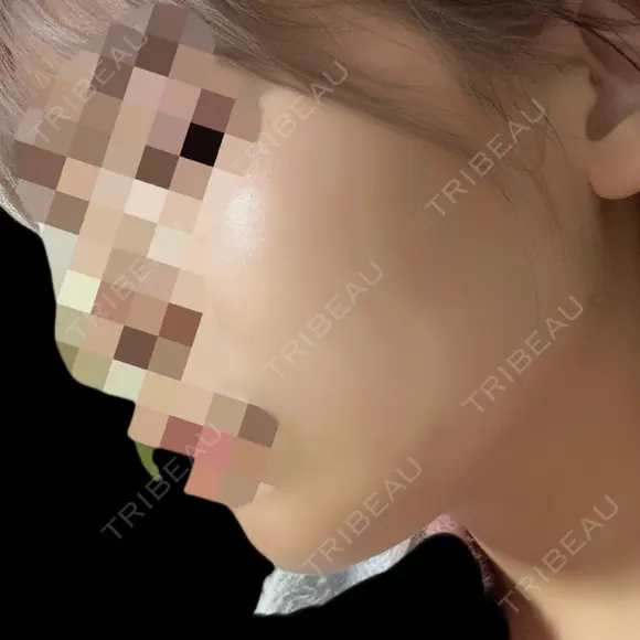 ハイフ（顔） Natural Skin Clinic 自由ヶ丘院 DAY 1 メイン用