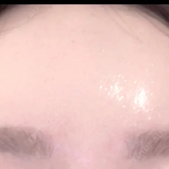 水光注射（ハリ・美肌） / 毛穴洗浄（ハイドラフェイシャルなど） RIN BEAUTY CLINIC DAY 12 メイン用