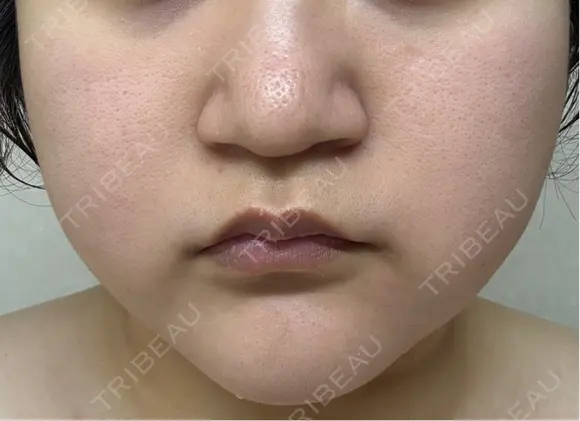 脂肪溶解注射（顔） ミニマムスキンクリニック池袋 DAY 0 メイン用