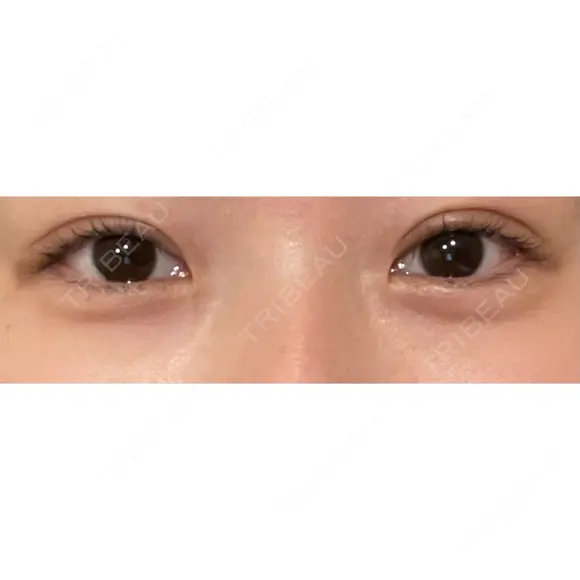 二重切開 / 眼瞼下垂（切開） / 上まぶたたるみ取り eクリニック 福岡院 AFTER メイン用