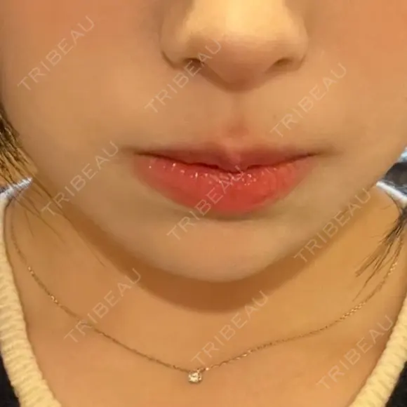 ヒアルロン酸注入（あご） / ボトックス（エラ・小顔） ルラ美容クリニック 名古屋本院 DAY 0 メイン用