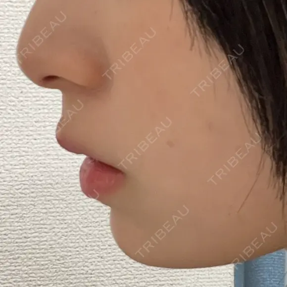 ヒアルロン酸注入（あご） / ボトックス（エラ・小顔） ルラ美容クリニック 名古屋本院 DAY 0 メイン用