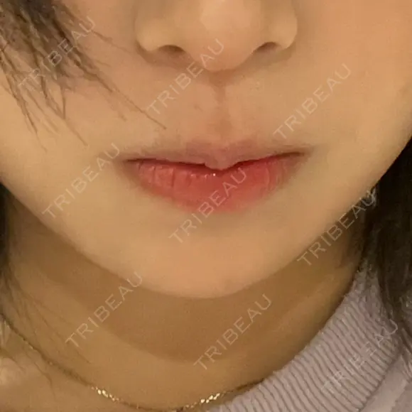 ヒアルロン酸注入（あご） / ボトックス（エラ・小顔） ルラ美容クリニック 名古屋本院 AFTER メイン用