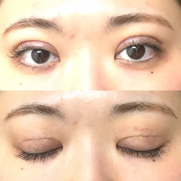 二重切開 EMMA CLINIC（エマクリニック） DAY 10 メイン用