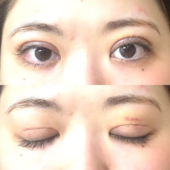 二重切開 EMMA CLINIC（エマクリニック） DAY 7 メイン用