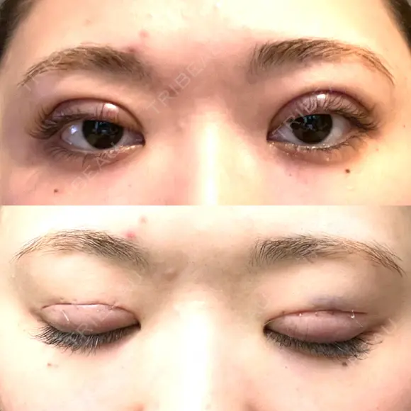 二重切開 EMMA CLINIC（エマクリニック） DAY 0 メイン用