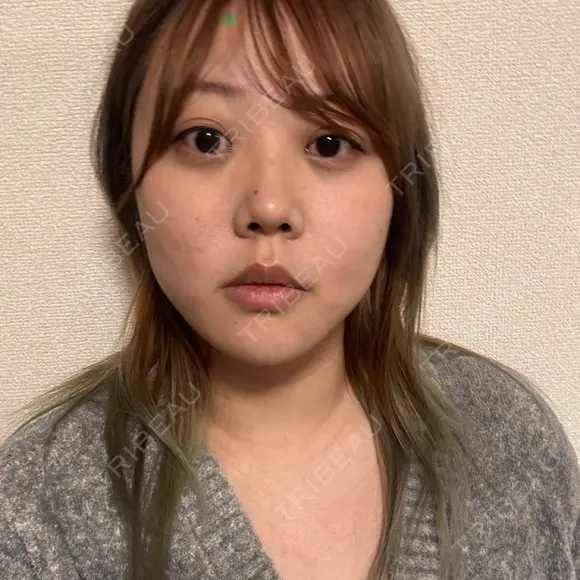 クマ治療 / 脂肪吸引（顔） 新宿美容外科ネビュラクリニック DAY 22 メイン用