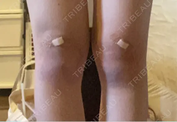 その他（ボディ） イテウォンビューティークリニック 大阪心斎橋院 DAY 8 メイン用