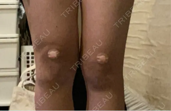 その他（ボディ） イテウォンビューティークリニック 大阪心斎橋院 DAY 11 メイン用