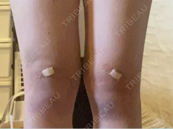 その他（ボディ） イテウォンビューティークリニック 大阪心斎橋院 DAY 9 メイン用