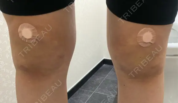 その他（ボディ） イテウォンビューティークリニック 大阪心斎橋院 DAY 4 メイン用