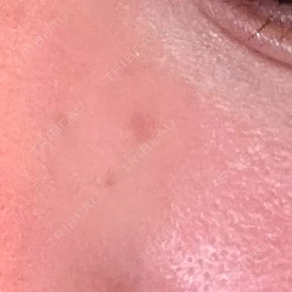 ほくろ・いぼ除去レーザー（肌） 心斎橋KT美容クリニック AFTER メイン用